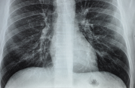Radiographie des poumons